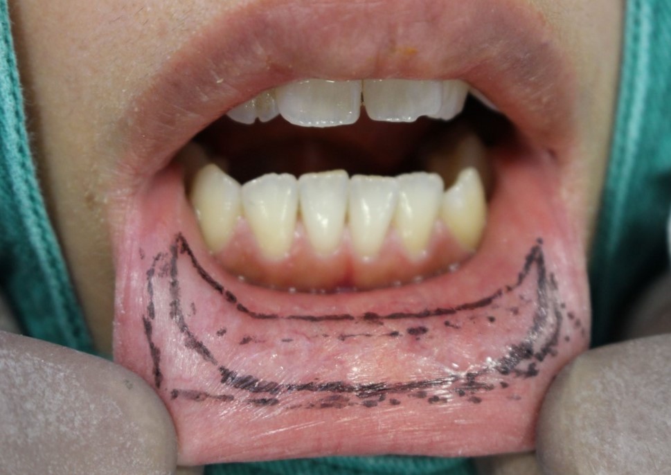 唇を薄くする手術方法について 口唇縮小手術 美容整形 美容外科 船橋中央 青山セレスクリニック