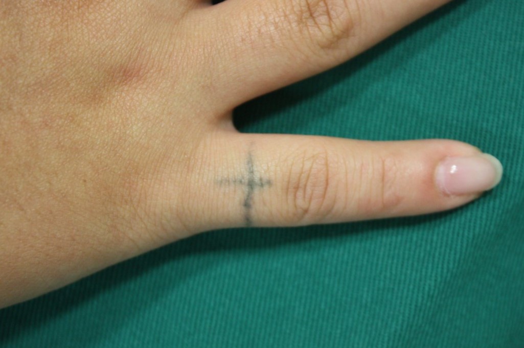 指の刺青 タトゥー の切除症例 美容整形 美容外科 船橋中央 青山セレスクリニック