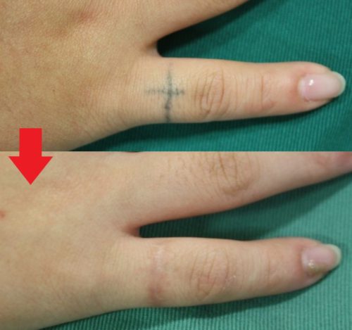 指の刺青（タトゥー）の切除症例