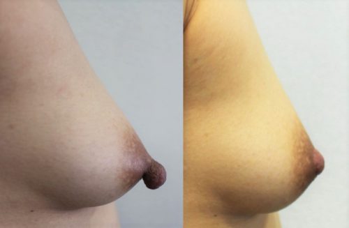 人気の乳首を小さくする手術