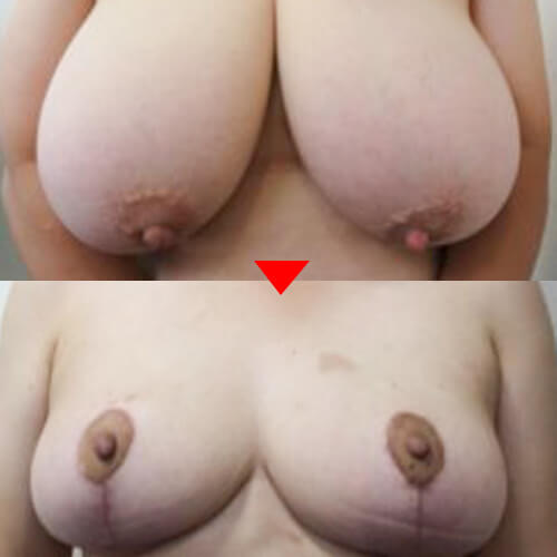乳房縮小手術 