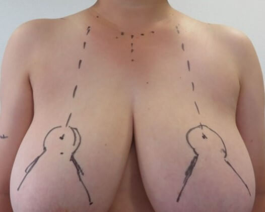 乳房縮小手術② 