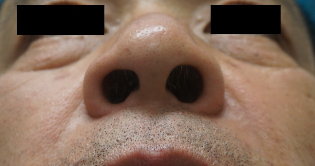小鼻縮小手術(外側切除法）