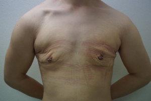 女性化乳房手術後