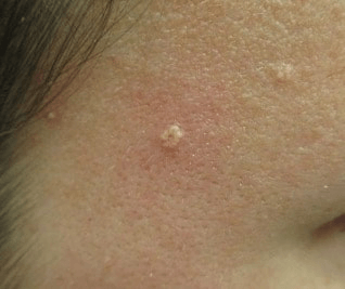 Bumps on the face: What are these? Could it be Sebaceous Gland Hyperplasia?