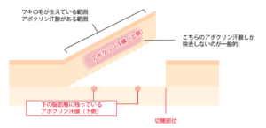 シェービング法の図