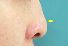鼻プロテーゼ移動例
