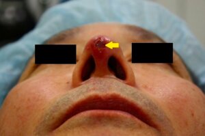 鼻プロテーゼが突き出た例１