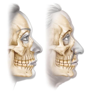 上顎骨の骨吸収