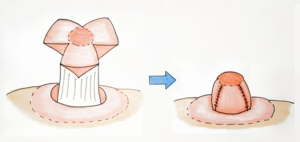 男性乳頭縮小手術ケーキ型法