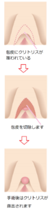 クリトリス包茎の術式