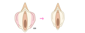 小陰唇縮小手術