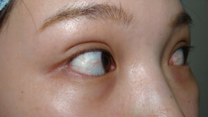 逆さまつ毛術前