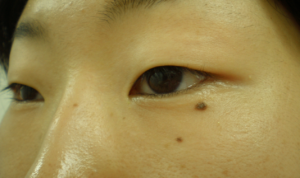 逆さまつ毛術前