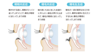 逆さ睫毛のイラスト