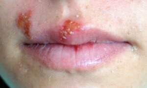 ヘルペス口唇炎とフォアダイスの違い