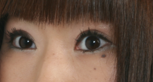 逆さまつ毛術後
