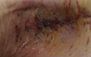 ワキガ手術後の皮弁のすだれ状の寄れと瘢痕