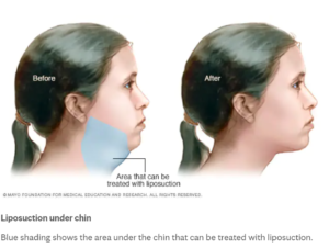 頬と顎の脂肪吸引の効果