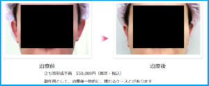 立ち耳を治す手術前後