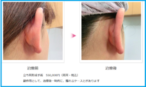 立ち耳を治す手術前後
