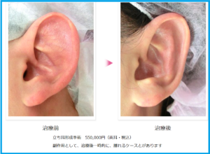 立ち耳を治す手術前後