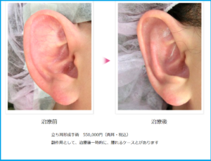 立ち耳を治す手術前後
