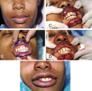 口唇縮小手術の写真