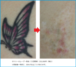 タトゥーのレーザー治療前後の写真