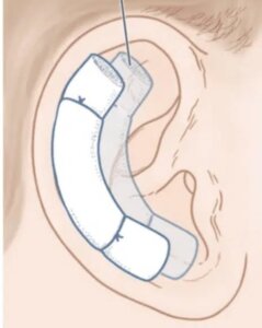 立ち耳のボルスター固定