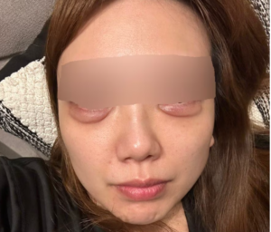 TCBでの涙袋の写真直後