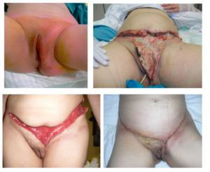 女性のフルニエ壊疽