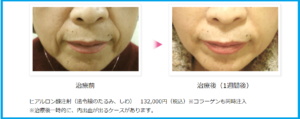 ほうれい線へのヒアルロン酸治療前後の写真