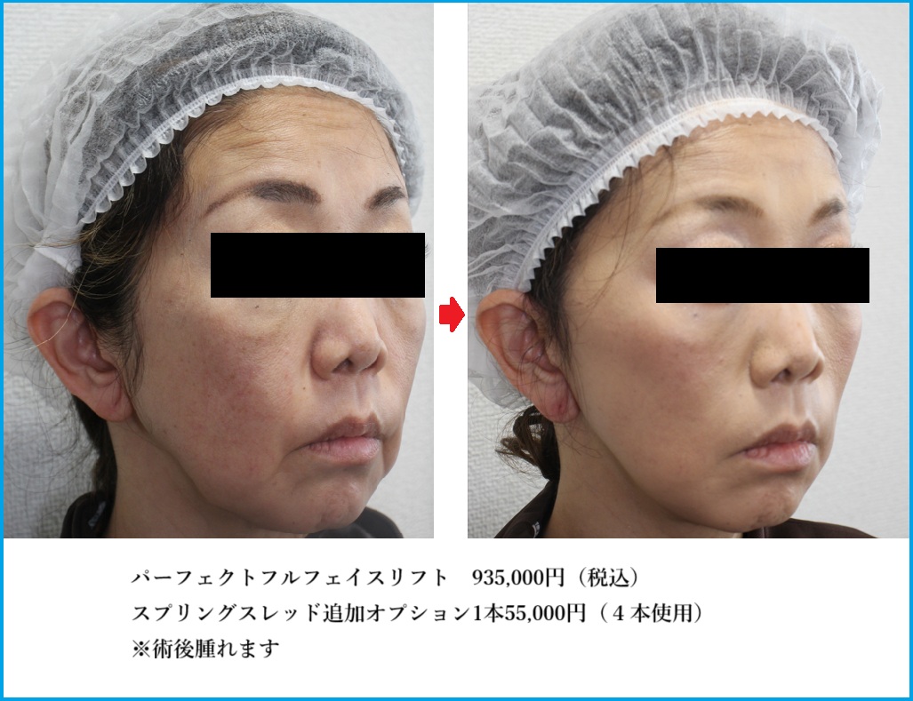 スプリングスレッド＋フェイスリフト