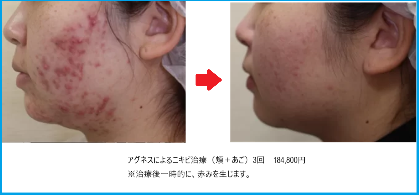 アグネス治療前後