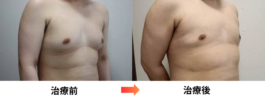 女性化乳房と陥没乳頭の男性患者の治療経過