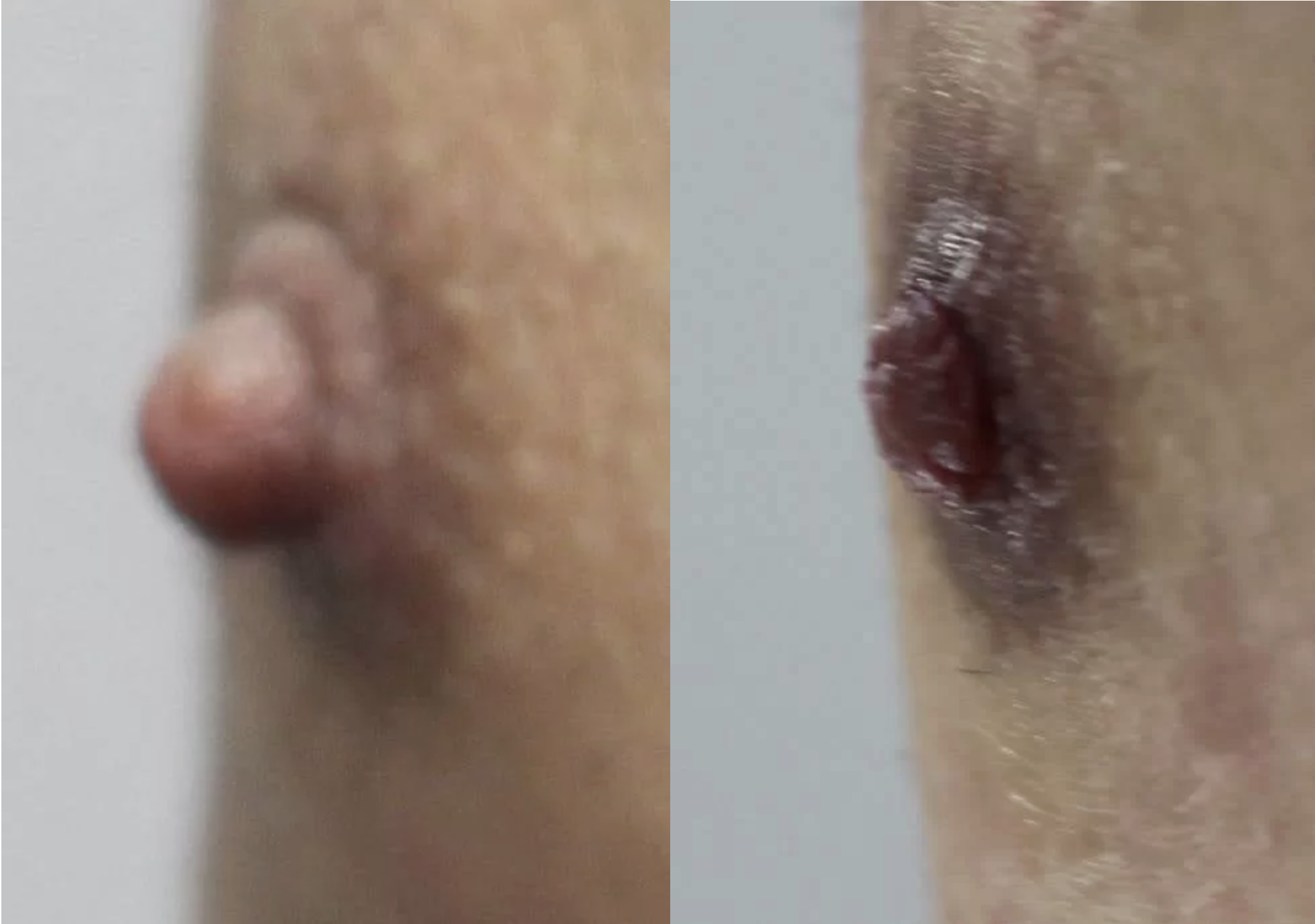 男性の乳首を小さくする手術（画像多数あり）